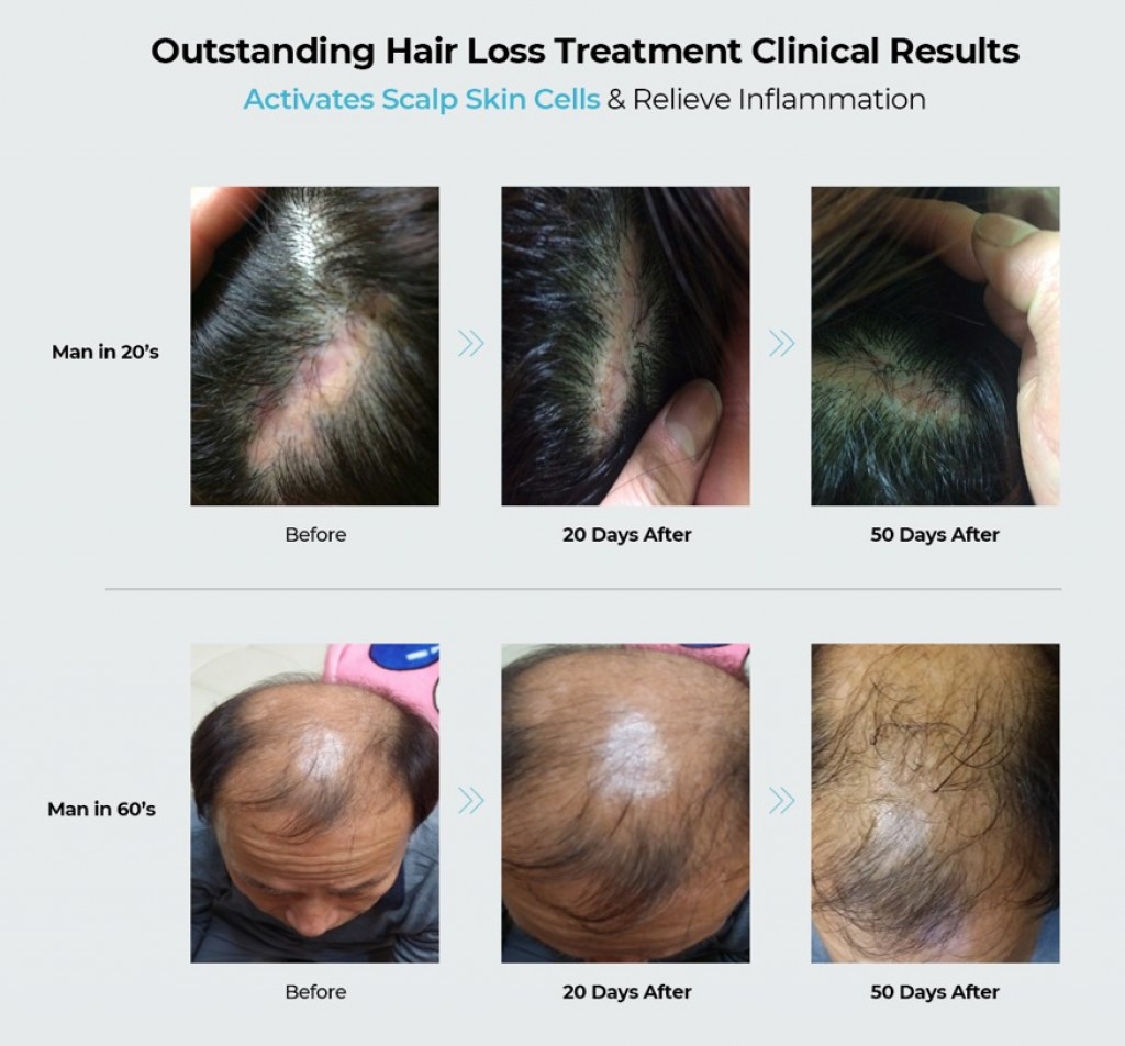 outstanding hair loss treatment clinical results